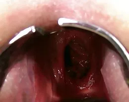 KINKYNIKY DOUBLE ANAL FISTING PROLAPSE XO SPECULUM GAPE